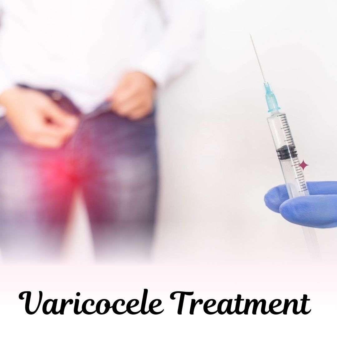 Varicocele Treatment